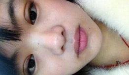 减肥埋线视频全过程,轻松减脂，重塑健康体态